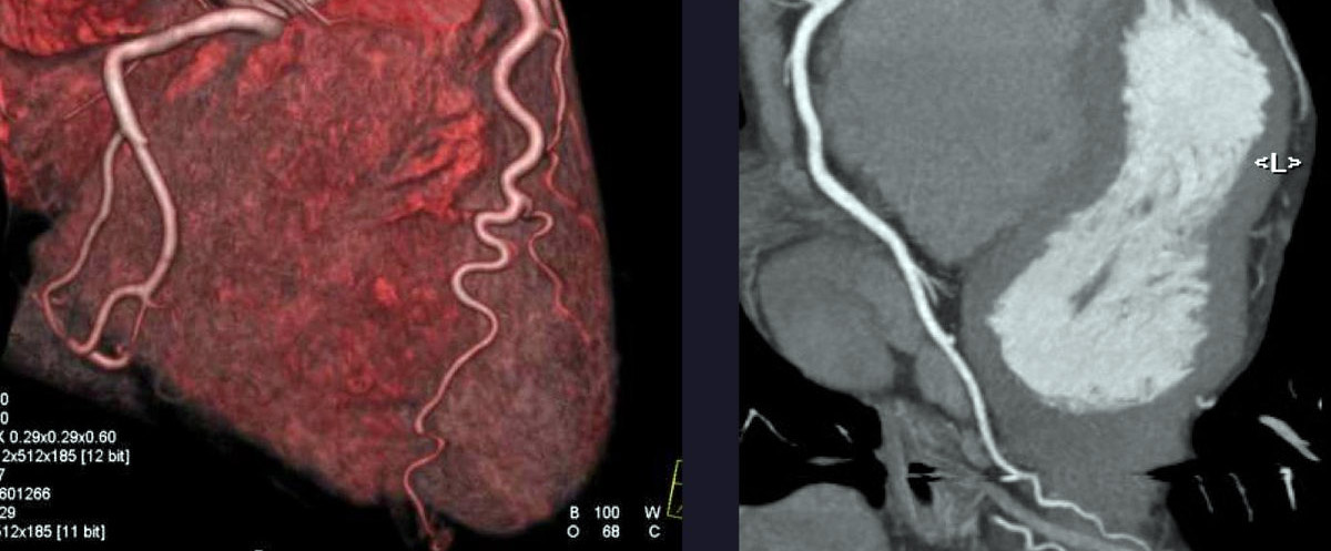 Koroner ve Kardiyak BT Anjiyografi