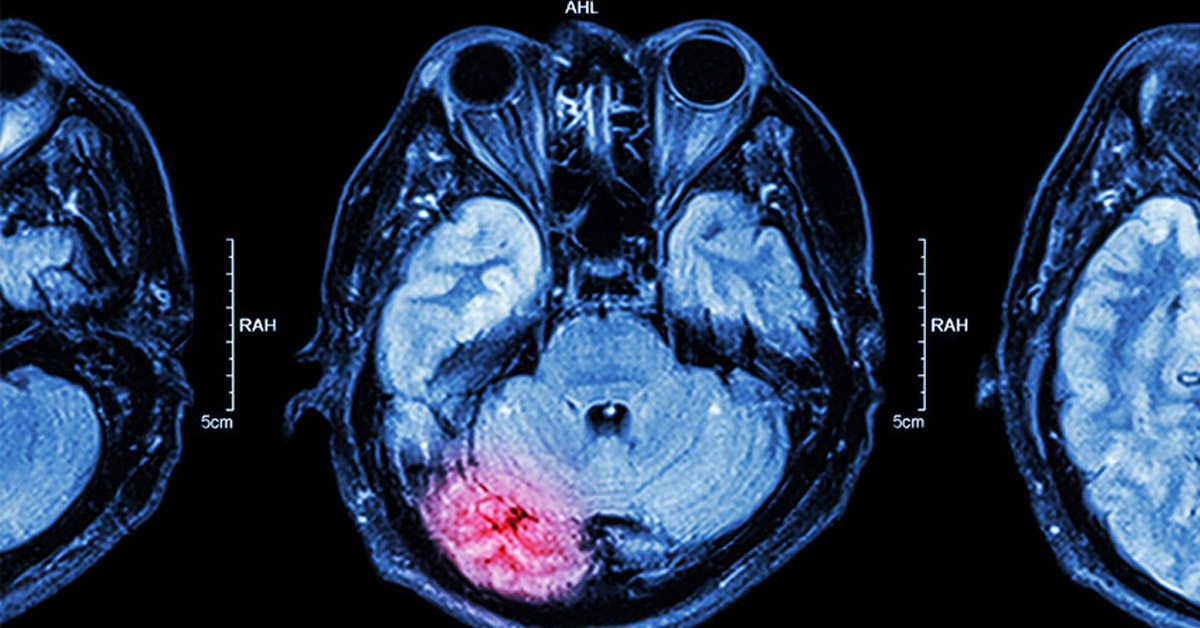 Nörolojik Görüntüleme